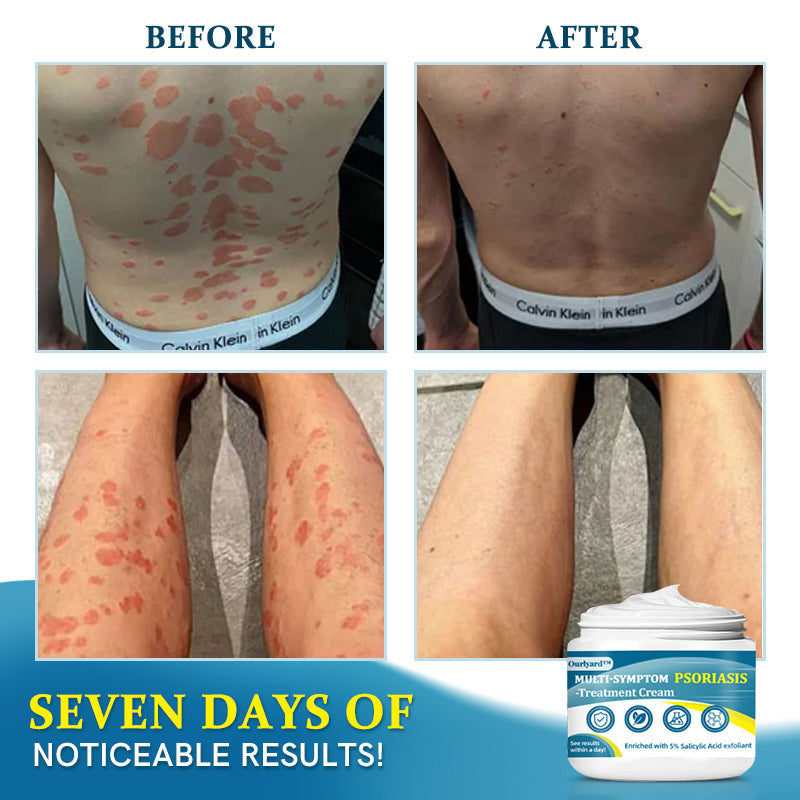 Ourlyard™ Multi-Symptom Psoriasis Treatment Cream👨⚕Doctor's Recommendation