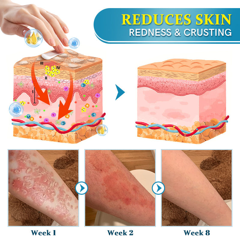 Ourlyard™ Multi-Symptom Psoriasis Treatment Cream👨⚕Doctor's Recommendation