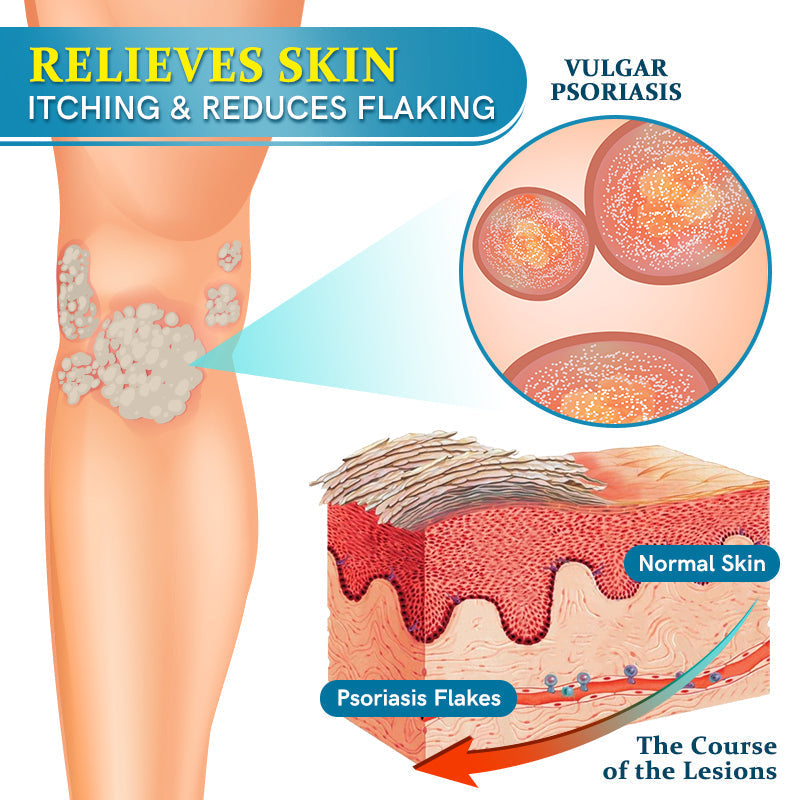 Ourlyard™ Multi-Symptom Psoriasis Treatment Cream👨⚕Doctor's Recommendation
